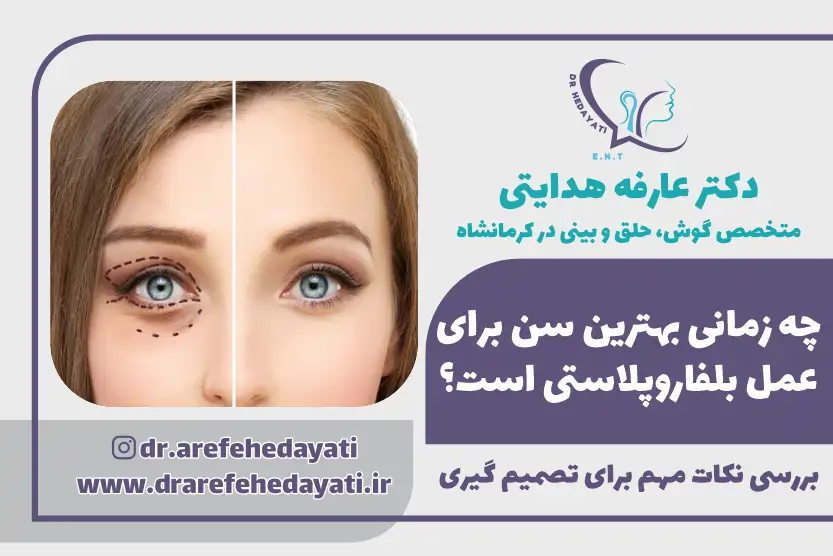 چه زمانی بهترین سن برای عمل بلفاروپلاستی است