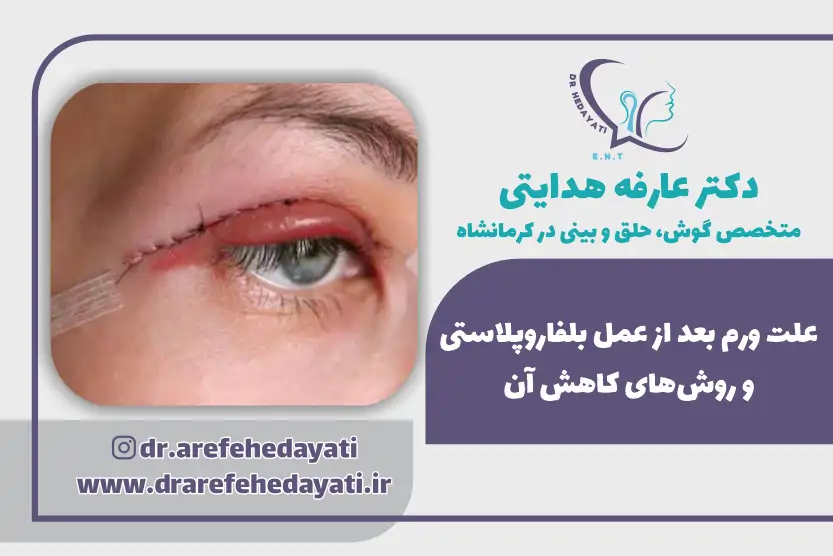 علت ورم بعد از عمل بلفاروپلاستی و روش های کاهش آن