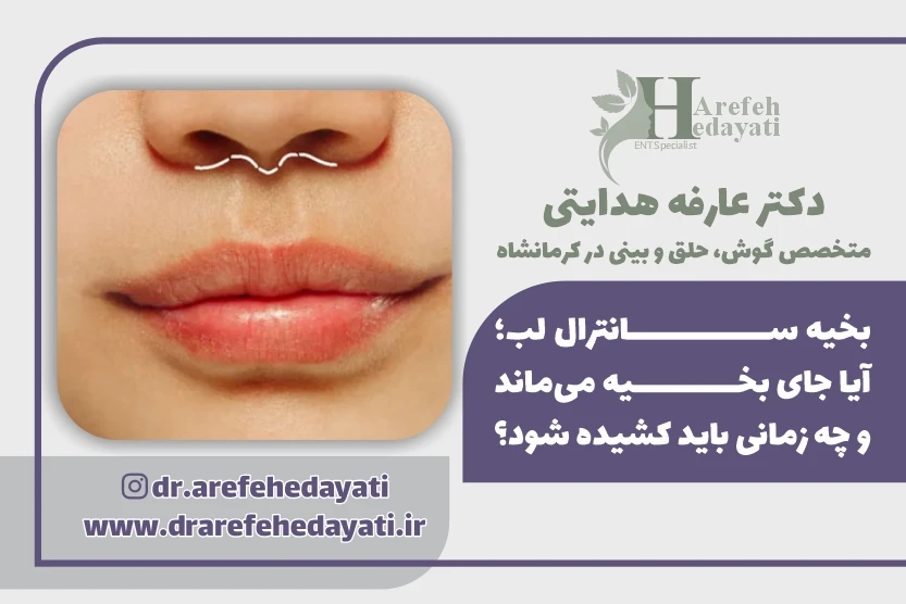 بخیه سانترال لب آیا جای بخیه می_ماند و چه زمانی باید کشیده شود؟